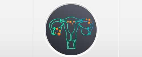 Endometriose: diagnóstico e tratamento indicado