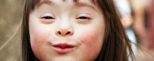 A nutrição na promoção de qualidade de vida das pessoas com Síndrome de Down